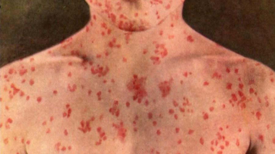 A person with a measles rash is seen in this file photo.