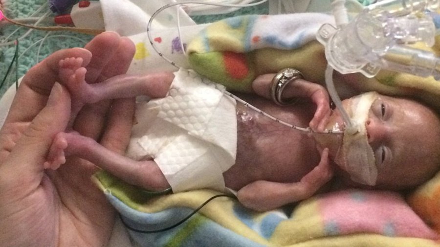 A now 3-year-old girl is seen after she was born at just 21 weeks and four days gestation. (Credit: Courtney Stensrud via CNN)