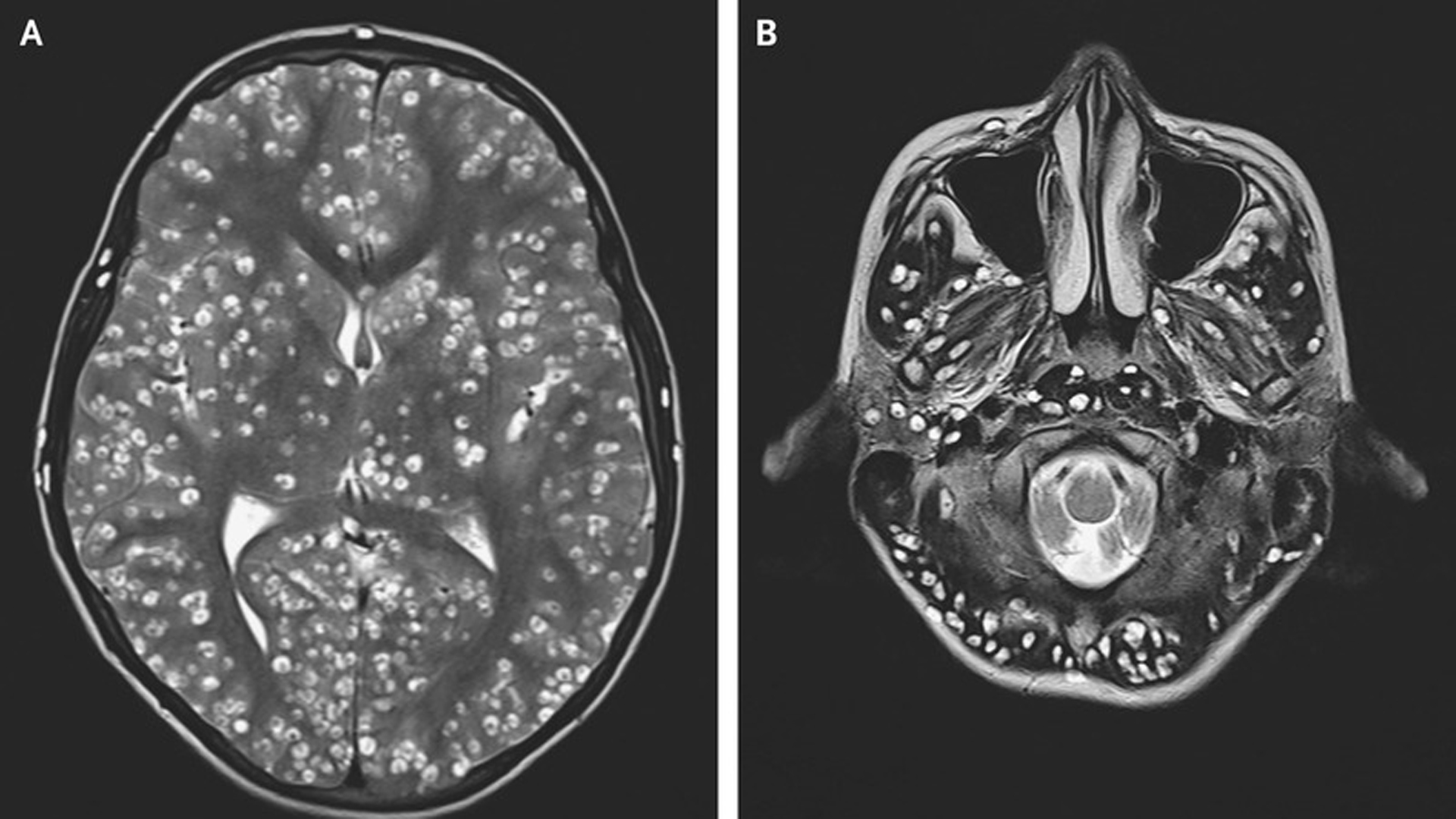 Damage-causing cysts were seen on MRI scans of the patient's cerebral cortex and brain stem. (Credit: Dr. Nishanth Dev/Dr. S. Zafar Abbas/ESIC Medical College & Hospital)