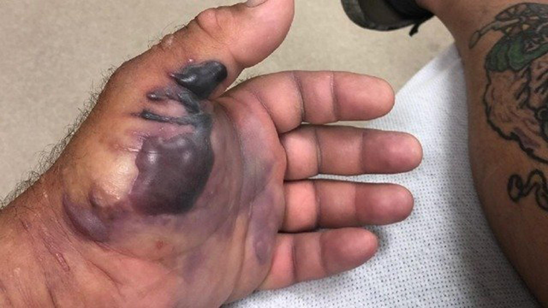 A photo of Mike Walton's hand after he contracted flesh-eating bacteria. (Credit: WFTS)