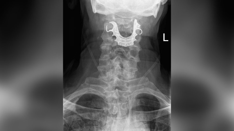 A 72-year-old's false teeth got stuck in his throat during surgery and weren't discovered for eight days, doctors have said. (Credit: BMJ)