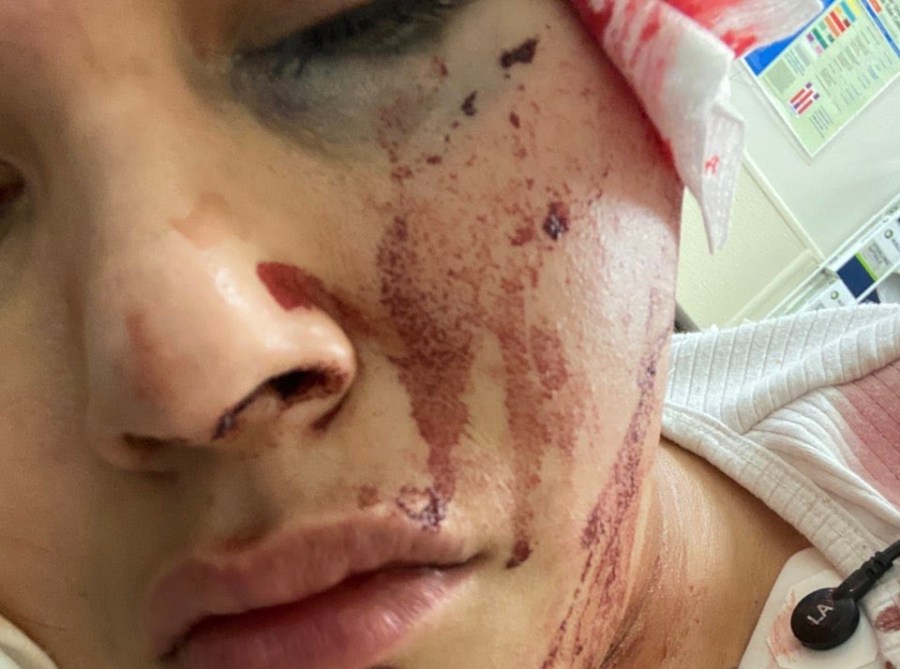 Jasmine Morales, 26, spent nine days hospitalized at Cedars Sinai Medical Center after she says a foam bullet hit her head. (West Coast Trial Lawyers)