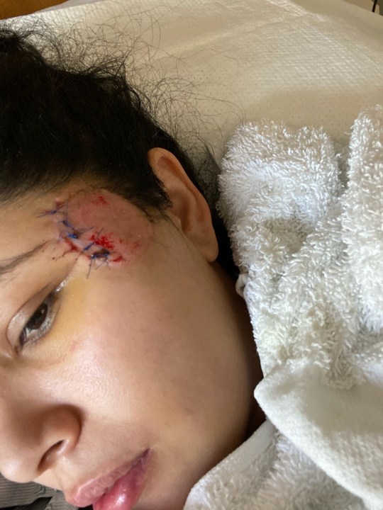 Jasmine Morales, 26, spent nine days hospitalized at Cedars Sinai Medical Center after she says a foam bullet hit her head. (West Coast Trial Lawyers)