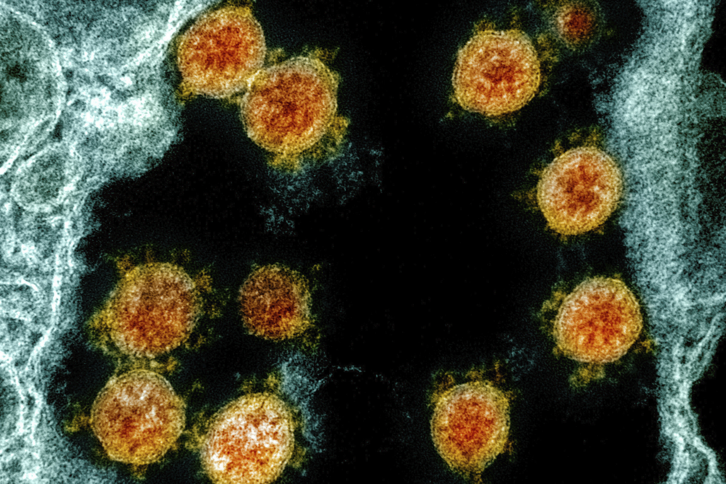 This electron microscope image made available and color-enhanced by the National Institute of Allergy and Infectious Diseases Integrated Research Facility in Fort Detrick, Md., shows Novel Coronavirus SARS-CoV-2 virus particles, orange, isolated from a patient. (NIAID/National Institutes of Health via AP)