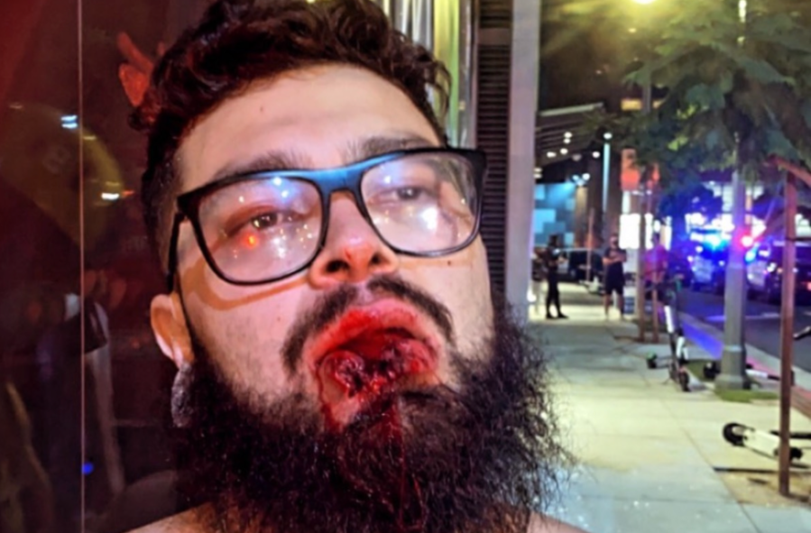 Manny Barrientos is seen on Oct. 13, 2020, in downtown L.A. after allegedly being shot by a rubber bullet. (GoFundMe)