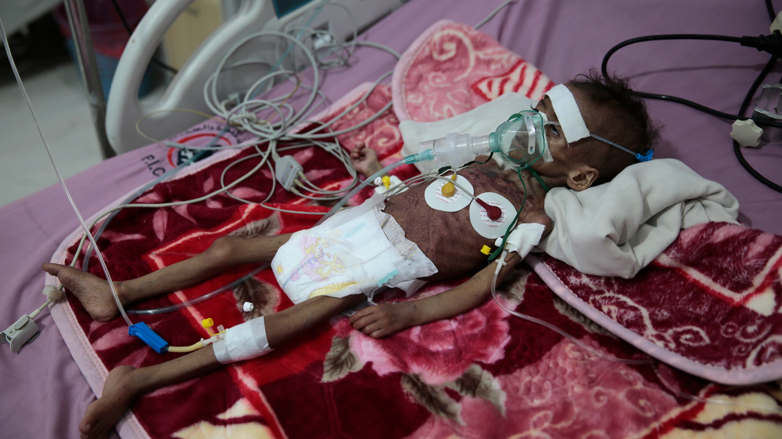 A malnourished girl Rahmah Watheeq receives treatment at a feeding center at Al-Sabeen hospital in Sanaa, Yemen, Tuesday. Nov. 3, 2020. (Hani Mohammed/AP Photo)