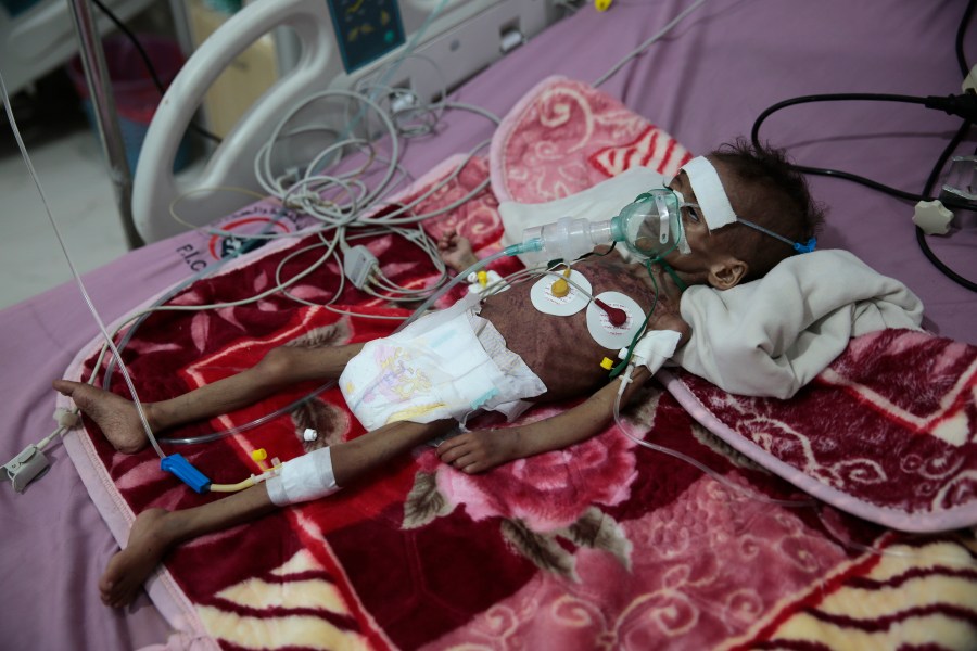 A malnourished girl Rahmah Watheeq receives treatment at a feeding center at Al-Sabeen hospital in Sanaa, Yemen, Tuesday. Nov. 3, 2020. (Hani Mohammed/AP Photo)