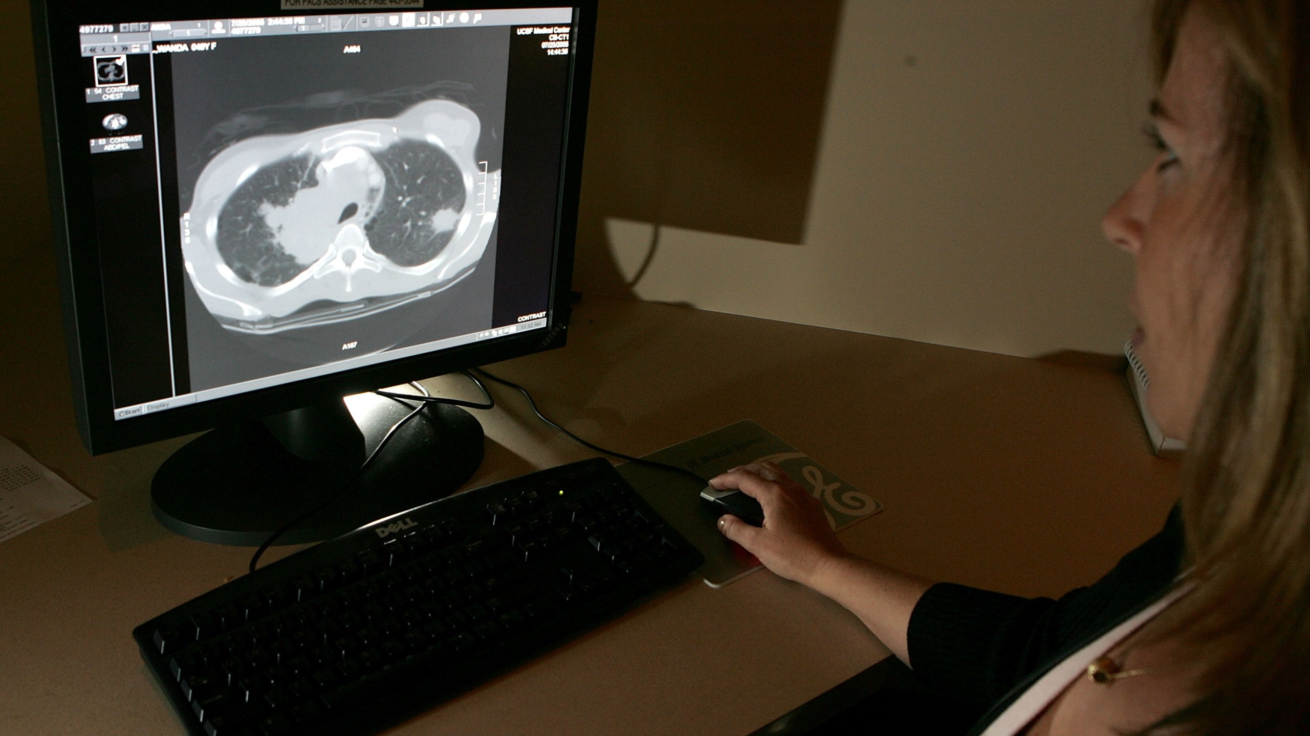 A file photo from Aug. 17, 2005 shows radiology technologist Mary McPolin looking at a CT scan of a lung with a tumor at the UCSF Comprehensive Cancer Center in San Francisco. (Justin Sullivan/Getty Images)