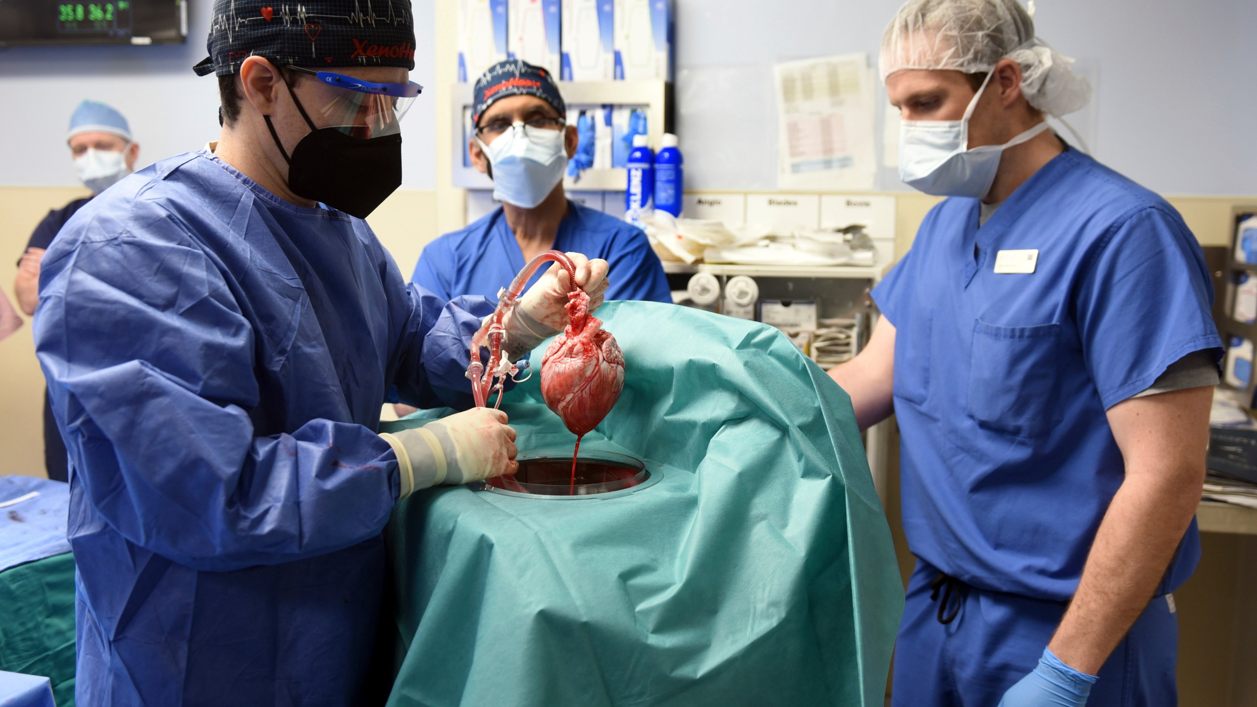 In this photo provided by the University of Maryland School of Medicine, members of the surgical team show the pig heart for transplant into patient David Bennett in Baltimore on Jan. 7, 2022. On Monday, Jan. 10, 2022, the hospital said that he's doing well three days after the highly experimental surgery. (Mark Teske/University of Maryland School of Medicine via AP)