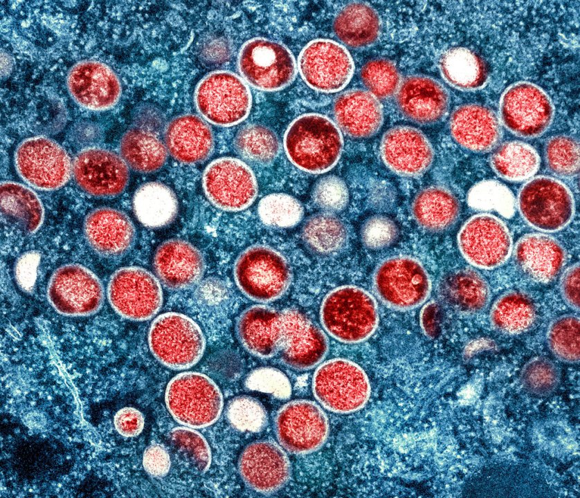 This image provided by the National Institute of Allergy and Infectious Diseases (NIAID) shows a colorized transmission electron micrograph of monkeypox particles (red) found within an infected cell (blue), cultured in the laboratory that was captured and color-enhanced at the NIAID Integrated Research Facility (IRF) in Fort Detrick, Md. (NIAID via AP)