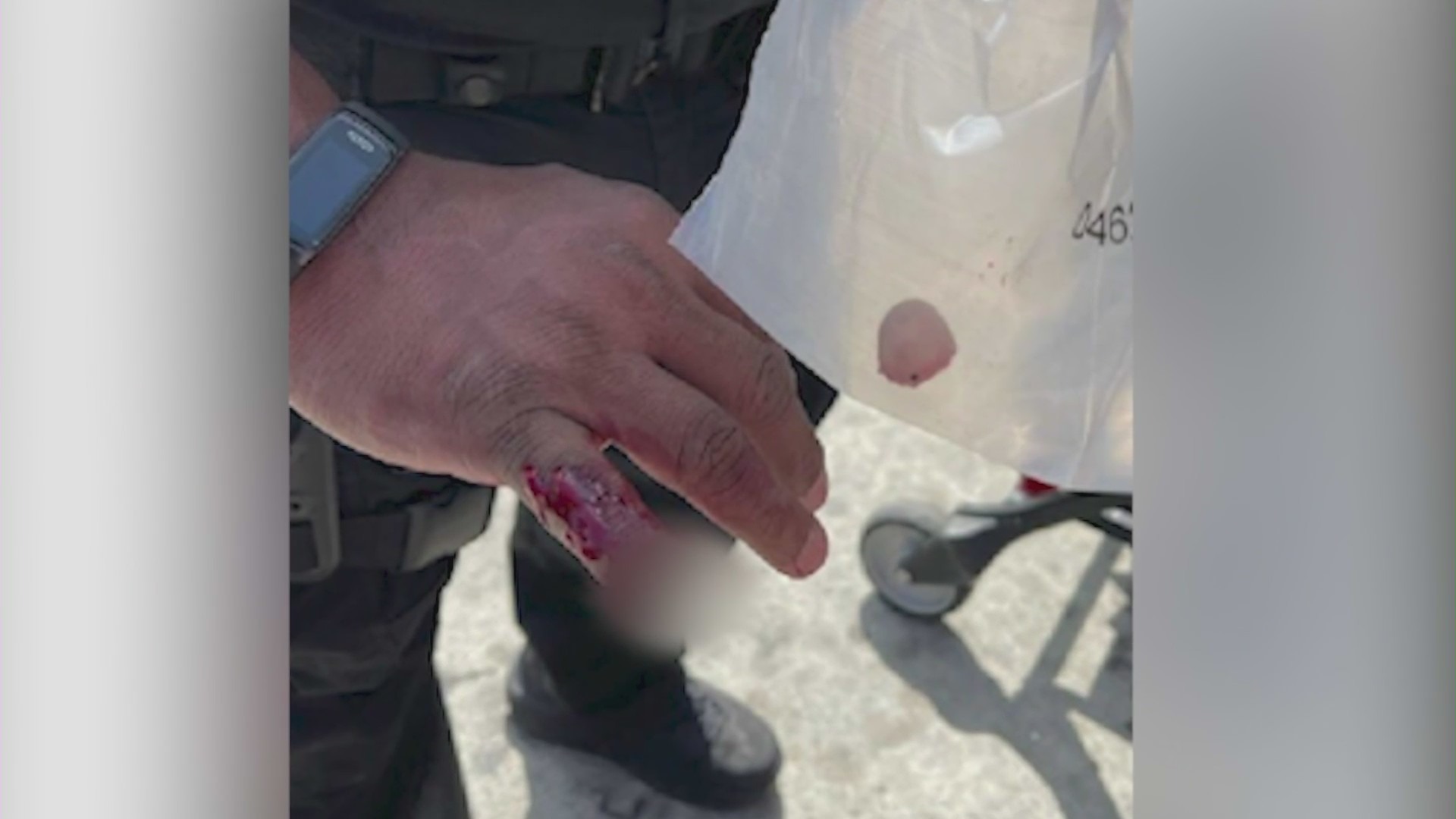 A portion of an Los Angeles police sergeant's pinky finger was bitten off by a homeless man during an arrest at the Metro Red Line subway station on April 27, 2023. (LAPD)