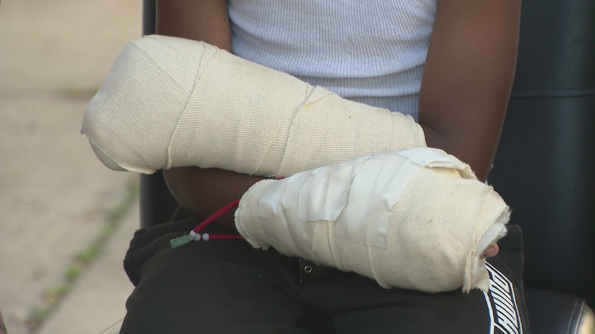 12-year-old Anthony Gibson from South Los Angeles is facing a long recovery after a painful upcoming surgery after an illegal firework went off in his hand in a post-Fourth of July celebration. (Gibson Family)