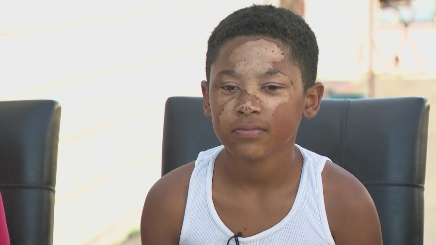 12-year-old Anthony Gibson from South Los Angeles is facing a long recovery after a painful upcoming surgery after an illegal firework went off in his hand in a post-Fourth of July celebration. (Gibson Family)