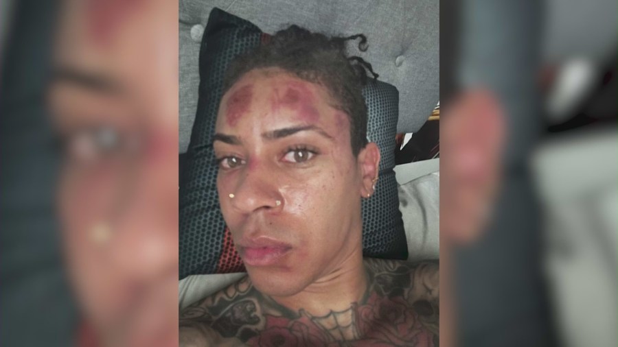 Absalom Wilkins was left bloodied and bruised after armed suspects robbed him at gunpoint at the Del Amo Fashion Center on Dec. 23, 2023. (Absalom Wilkins)