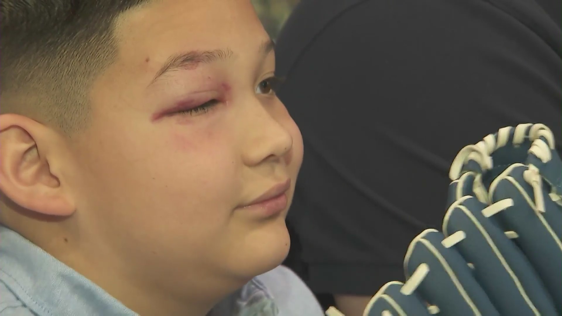 Nathan Sanchez was left with a black eye after being hit in the face by a foul ball at Dodgers Stadium on May 17, 2024. (KTLA)