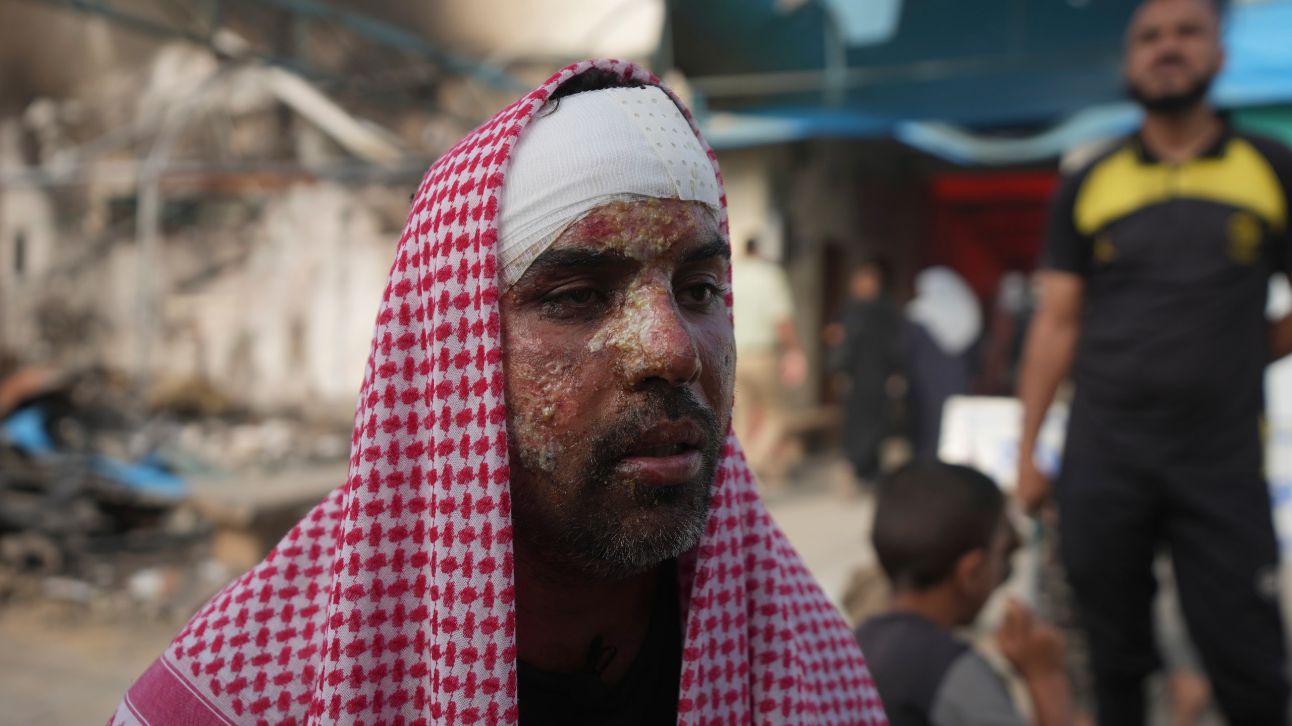 Ahmad al-Dalu, suffering from burns, lost his son, Shaban, in a fire after an Israeli strike hit a tent area in the courtyard of Al Aqsa Martyrs hospital in Deir al-Balah, Gaza Strip, at the site on Wednesday, Oct. 16, 2024. (AP Photo/Abdel Kareem Hana)